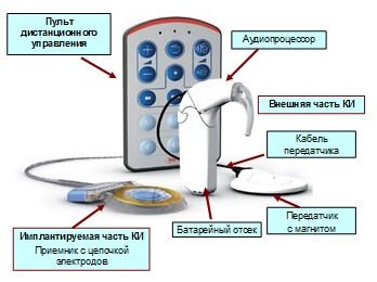 Рисунок 2. Внешняя и имплантируемая части кохлеарного импланта. Расположение внешней части кохлеарного импланта на голове пациента Рисунок 2. Внешняя и имплантируемая части кохлеарного импланта. Расположение внешней части кохлеарного импланта на голове пациента