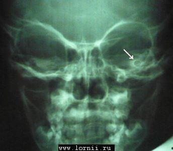 Рис. 4. Трансорбитальная рентгенография. Укороченный электрод в общей полости. Рис. 4. Трансорбитальная рентгенография. Укороченный электрод в общей полости.