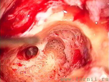Рис. 8. Антромастоидотомия, задняя тимпанотомия (левое ухо) Рис. 8. Антромастоидотомия, задняя тимпанотомия (левое ухо)