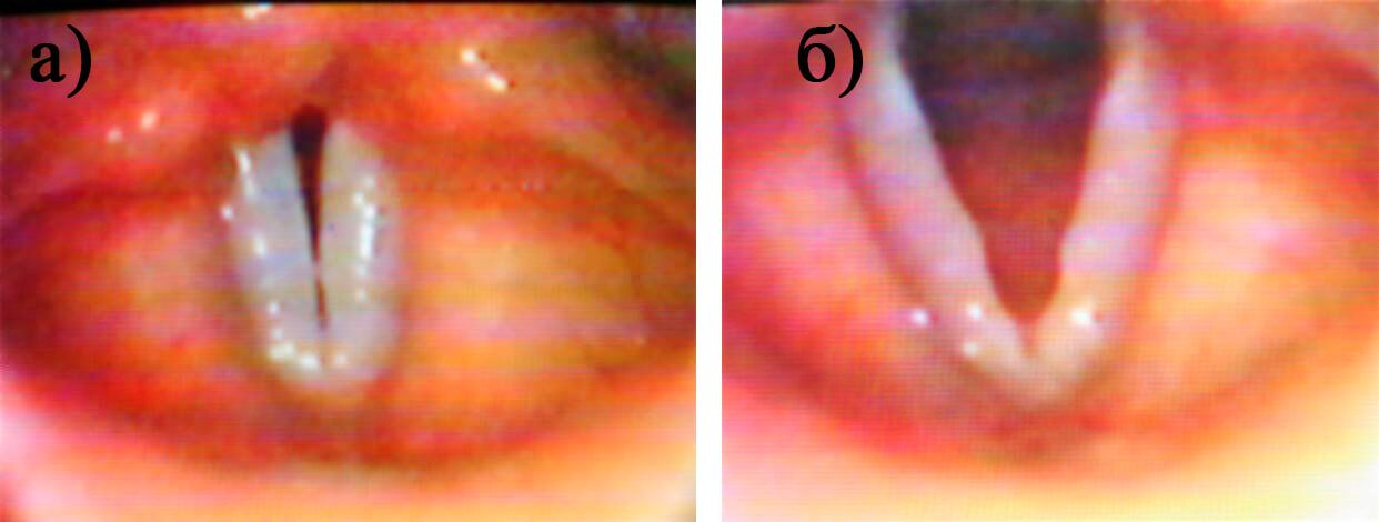 Рис.1. Мягкие узелки голосовых складок при фонации (а) и дыхании (б) у больной М., 11 лет Рис.1. Мягкие узелки голосовых складок при фонации (а) и дыхании (б) у больной М., 11 лет