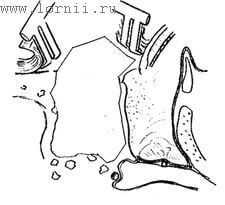Рис.1. Доступ в барабанную полость при классической методике проведения КИ. Примечание: Стрелка указывает на место наложения задней тимпаностомы. Рис.1. Доступ в барабанную полость при классической методике проведения КИ. Примечание: Стрелка указывает на место наложения задней тимпаностомы.