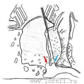 Рис. 2. Схематическое изображение комбинированного подхода. Примечание: (красная стрелка) подход к барабанной полости через заднюю тимпаностому; (синяя стрелка) тимпанотомия через НСП. Рис. 2. Схематическое изображение комбинированного подхода. Примечание: (красная стрелка) подход к барабанной полости через заднюю тимпаностому; (синяя стрелка) тимпанотомия через НСП.