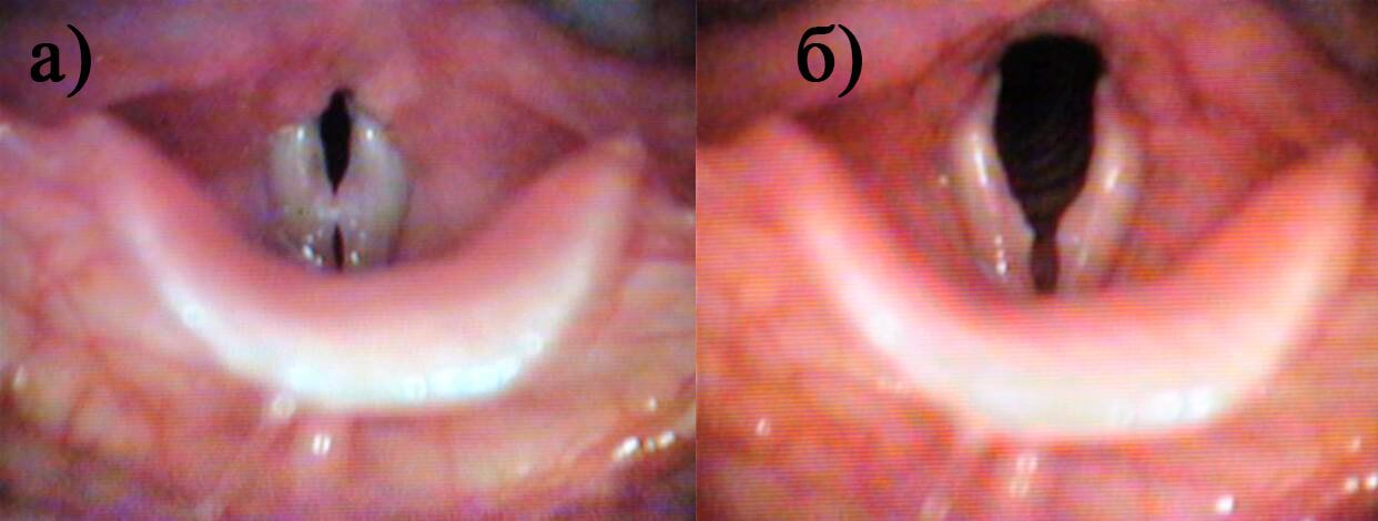 Рис.2. Жесткие узелки голосовых складок при фонации (а)   и дыхании (б) у больного В., 6 лет Рис.2. Жесткие узелки голосовых складок при фонации (а)   и дыхании (б) у больного В., 6 лет