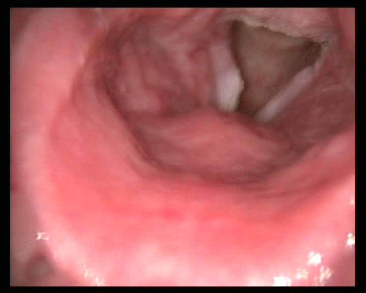 Рис. 5 Видеоэндоскопия и аутофлюоресцентная эндоскопия пациента с раком левой голосовой складки  T2N0Mx  (Высокодифференцированный плоскоклеточный ороговевающий рак) (AF-) Рис. 5 Видеоэндоскопия и аутофлюоресцентная эндоскопия пациента с раком левой голосовой складки  T2N0Mx  (Высокодифференцированный плоскоклеточный ороговевающий рак) (AF-)