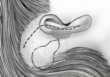 Рис.6. Схема разреза кожи Рис.6. Схема разреза кожи