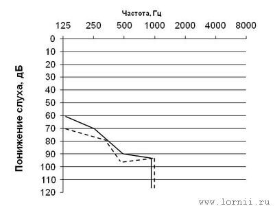 Диаграмма  2. - Уровни восприятия чистых тонов до и после КИ у пациентов с остаточным слухом на оперированном ухе Диаграмма  2. - Уровни восприятия чистых тонов до и после КИ у пациентов с остаточным слухом на оперированном ухе