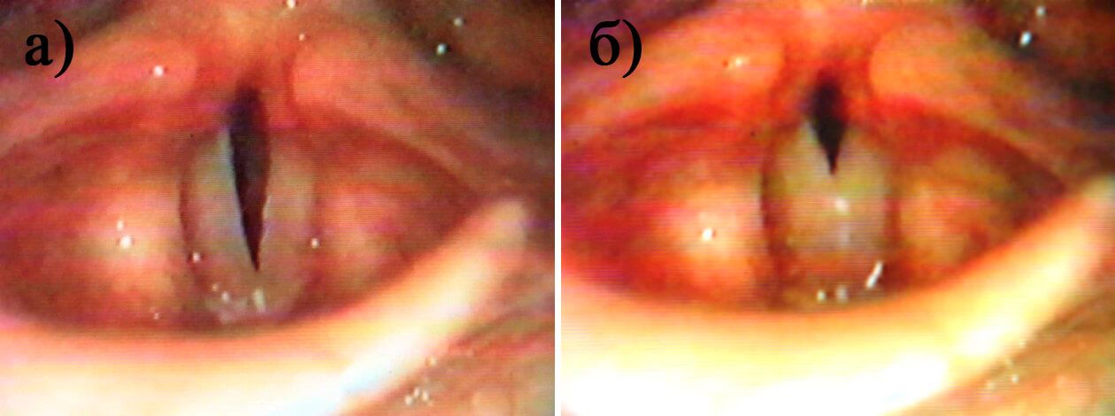 Рис. 4. Гортань мальчика А., 13 лет в период мутации при фонации в головном (а) и грудном (б) регистре Рис. 4. Гортань мальчика А., 13 лет в период мутации при фонации в головном (а) и грудном (б) регистре