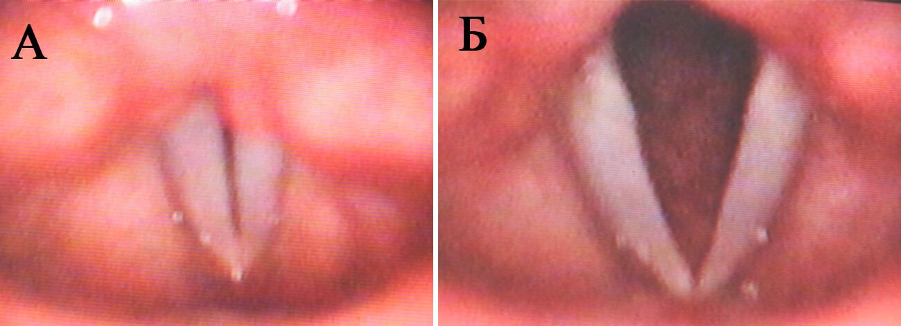 Рис.2. Предмутационные изменения гортани во время фонации (а) и дыхания (б) у девочки Т., 12 лет Рис.2. Предмутационные изменения гортани во время фонации (а) и дыхания (б) у девочки Т., 12 лет