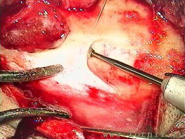 Рис.9. Подготовка ложа для импланта Рис.9. Подготовка ложа для импланта