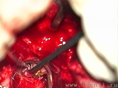 Рис.15. Укладка фасциального лоскута в окно улитки Рис.15. Укладка фасциального лоскута в окно улитки