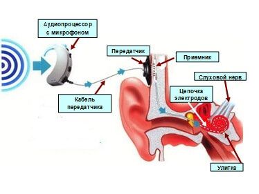 Рисунок 4. Как работает кохлеарный имплант Рисунок 4. Как работает кохлеарный имплант