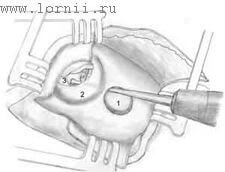 Рис.3. Наложение костного туннеля в толще НСП. Примечание: 1 – Супрамеатальная выемка для избытка электрода, 2 – задняя стенка НСП, 3 – вскрытая барабанная полость. Рис.3. Наложение костного туннеля в толще НСП. Примечание: 1 – Супрамеатальная выемка для избытка электрода, 2 – задняя стенка НСП, 3 – вскрытая барабанная полость.