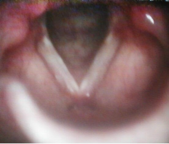 Рис. 3. Рефлюксный ларингит у больного Д., 12 лет Рис. 3. Рефлюксный ларингит у больного Д., 12 лет