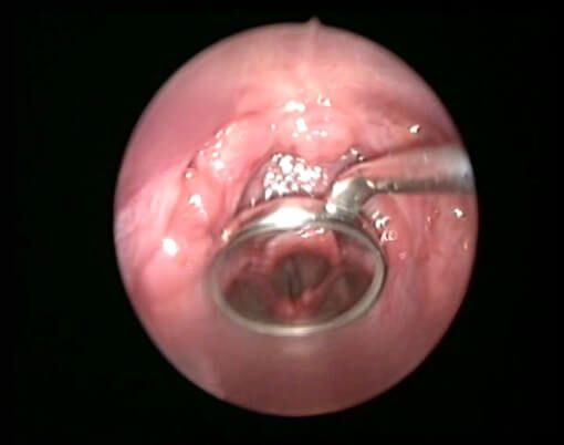 Рис.1 Вид гортани при непрямой ларингоскопии Рис.1 Вид гортани при непрямой ларингоскопии