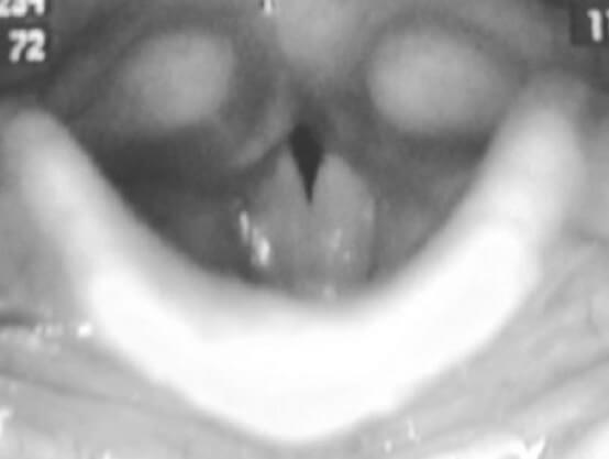 Рис.1. Треугольная щель в задней трети голосовых складок у мальчика П., 9 лет Рис.1. Треугольная щель в задней трети голосовых складок у мальчика П., 9 лет