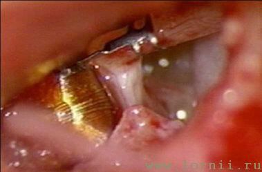 Рис.12. Фиксация катушки импланта на длинной ножке наковальни (AS) Рис.12. Фиксация катушки импланта на длинной ножке наковальни (AS)