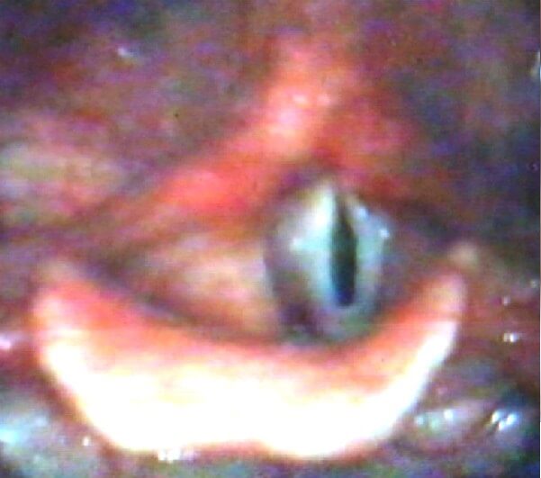 Рис. 3.8. Овальная щель при гипотонусной дисфонии  у больной Т., 8 лет Рис. 3.8. Овальная щель при гипотонусной дисфонии  у больной Т., 8 лет