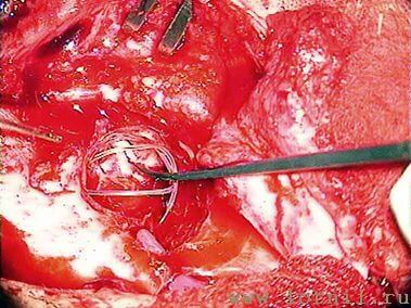 Рис.16. Фиксация катушки аутохрящевой полоской Рис.16. Фиксация катушки аутохрящевой полоской