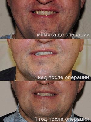 Смешанная опухоль околоушной слюнной железы Смешанная опухоль околоушной слюнной железы