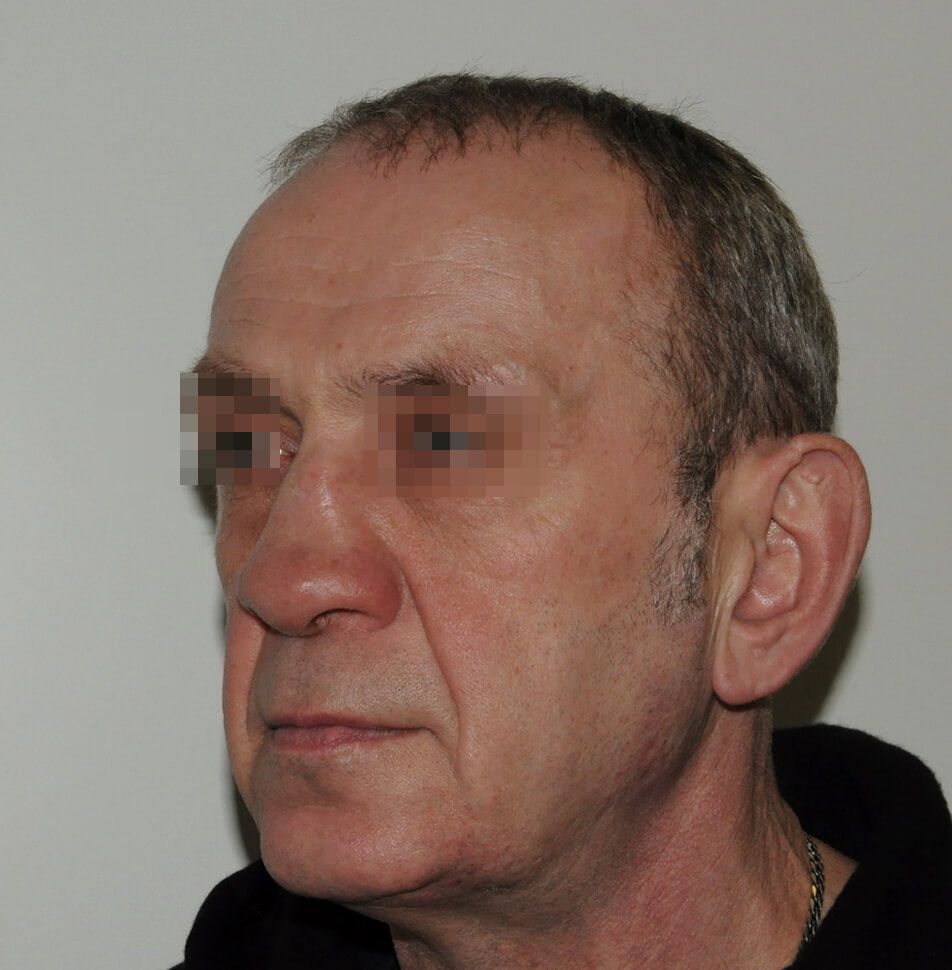 До операции До операции