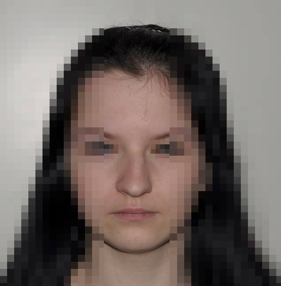 До операции До операции