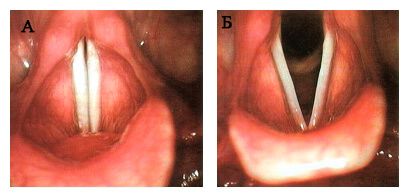 Рис.4 Эндоскопическая картина гортани, выполненная жестким эндоскопом с углом осмотра 90°во время фонации (а) и дыхания (б) Рис.4 Эндоскопическая картина гортани, выполненная жестким эндоскопом с углом осмотра 90°во время фонации (а) и дыхания (б)