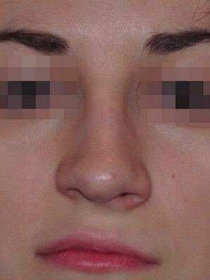 До операции До операции