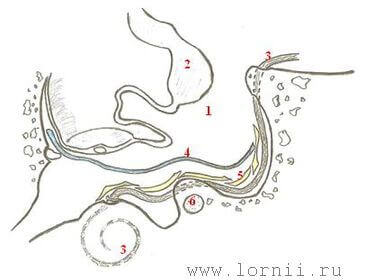 Рис. 7. Схематическое изображение КИ после РО уха. Примечание: 1 – просвет ТП, 2 – отслоенная выстилка ТП, 3 – активный электрод, 4 – фрагмент аутофасции (синий), 5 – полоски аутохряща (желтый), 6 – лицевой нерв. Рис. 7. Схематическое изображение КИ после РО уха. Примечание: 1 – просвет ТП, 2 – отслоенная выстилка ТП, 3 – активный электрод, 4 – фрагмент аутофасции (синий), 5 – полоски аутохряща (желтый), 6 – лицевой нерв.