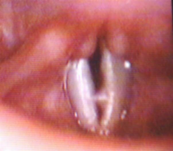 Рис. 4. Ангиоматозный полип левой голосовой складки  у больного С., 13 лет Рис. 4. Ангиоматозный полип левой голосовой складки  у больного С., 13 лет