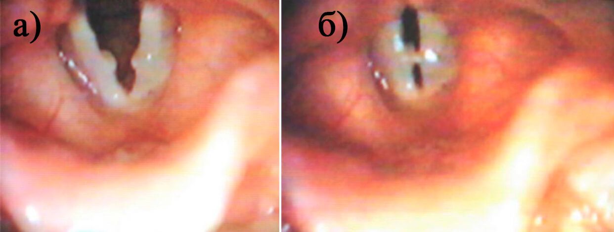 Рис. 3. Отечный полип правой и узелок левой голосовой складки при фонации (а) и дыхании (б) у больной Л., 12 лет Рис. 3. Отечный полип правой и узелок левой голосовой складки при фонации (а) и дыхании (б) у больной Л., 12 лет