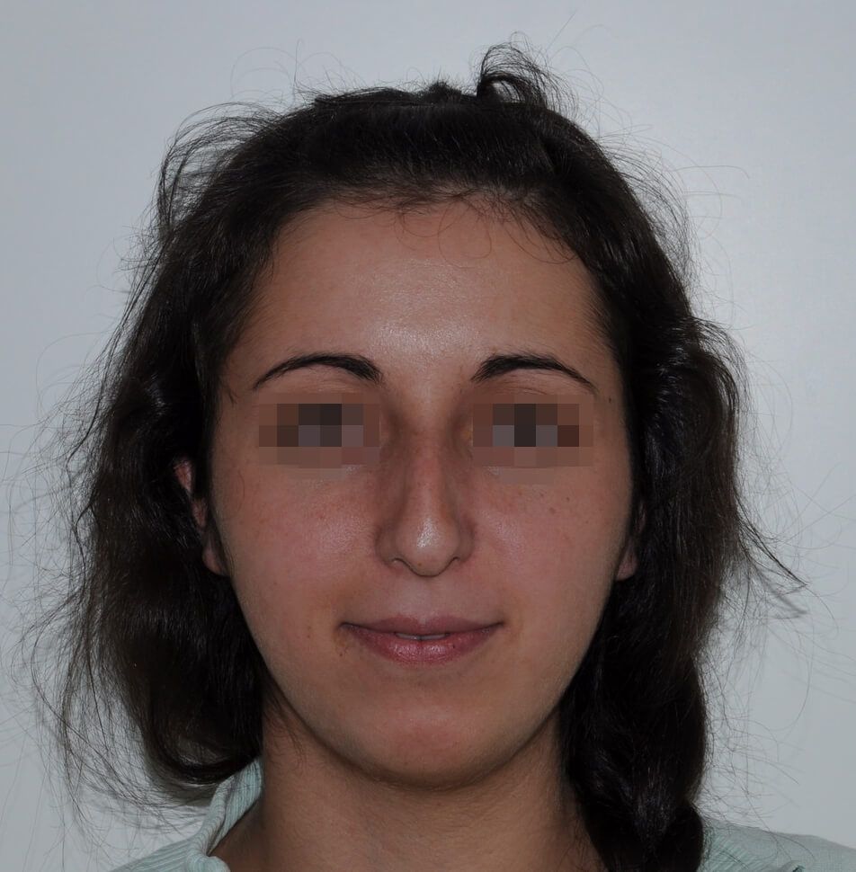 До операции До операции