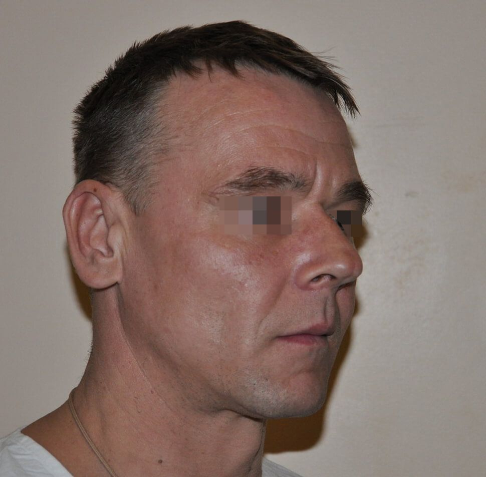 До операции До операции