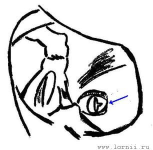 Рис. 3. Открытая мембрана окна улитки. Примечание: Костный навес удален. Стрелка указывает на разрез мембраны окна улитки перед введением электрода. Рис. 3. Открытая мембрана окна улитки. Примечание: Костный навес удален. Стрелка указывает на разрез мембраны окна улитки перед введением электрода.