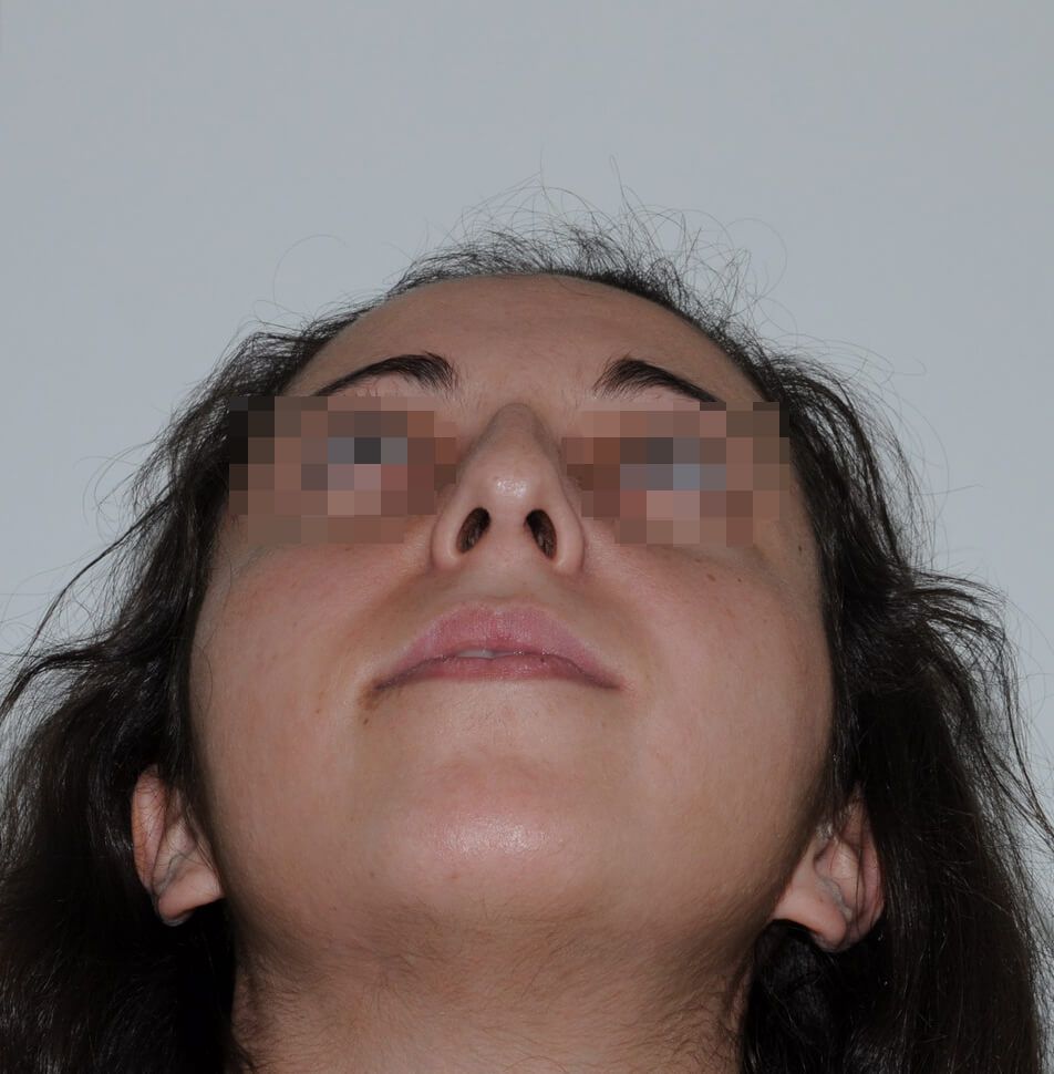 До операции До операции