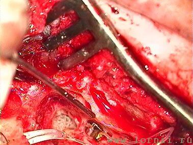 Рис.11. Фиксация катушки импланта на длинной ножке наковальни (AD) Рис.11. Фиксация катушки импланта на длинной ножке наковальни (AD)