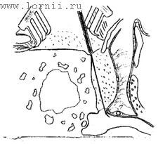Рис.2. Доступ в барабанную полость при Veria-операции. Примечание: Доступ осуществляется посредством тимпанотомии через наружный слуховой проход с циркулярным разрезом кожи, или, в нашей модификации,  путем отслойки кожи задней стенки НСП и барабанного ко Рис.2. Доступ в барабанную полость при Veria-операции. Примечание: Доступ осуществляется посредством тимпанотомии через наружный слуховой проход с циркулярным разрезом кожи, или, в нашей модификации,  путем отслойки кожи задней стенки НСП и барабанного ко