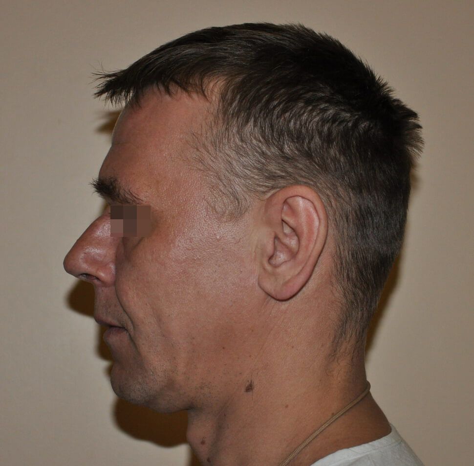 До операции До операции