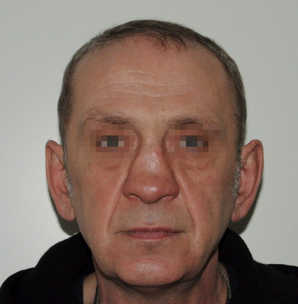 До операции До операции