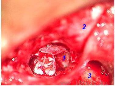 Рис. 1. Холестеатома в барабанной полости. Рис. 1. Холестеатома в барабанной полости.