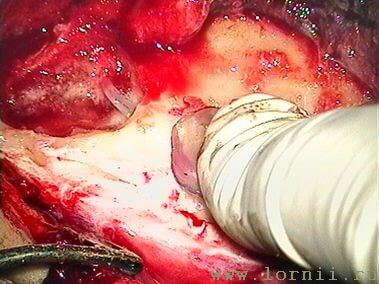 Рис.10. Фиксация импланта в ложе Рис.10. Фиксация импланта в ложе