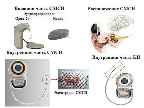 Рис.1. Внешняя и имплантируемая части стволомозгового слухового импланта. Рис.1. Внешняя и имплантируемая части стволомозгового слухового импланта.