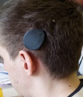 Рисунок 3. Моноблочная модель кохлеарного импланта Рисунок 3. Моноблочная модель кохлеарного импланта