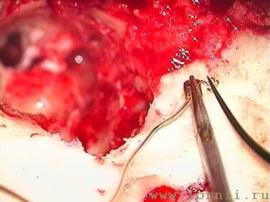 Рис.14. Подготовка катушки импланта Рис.14. Подготовка катушки импланта