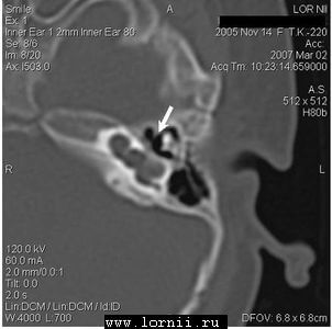 Рис.2. Расширенное преддверие слева Рис.2. Расширенное преддверие слева
