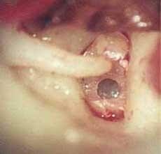 Рис.3. Расширение недостаточного  по размеру отверстия в подножной  пластинке стремени (левое ухо). Рис.3. Расширение недостаточного  по размеру отверстия в подножной  пластинке стремени (левое ухо).