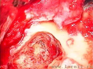 Рис.7. Антромастоидотомия (левое ухо) Рис.7. Антромастоидотомия (левое ухо)