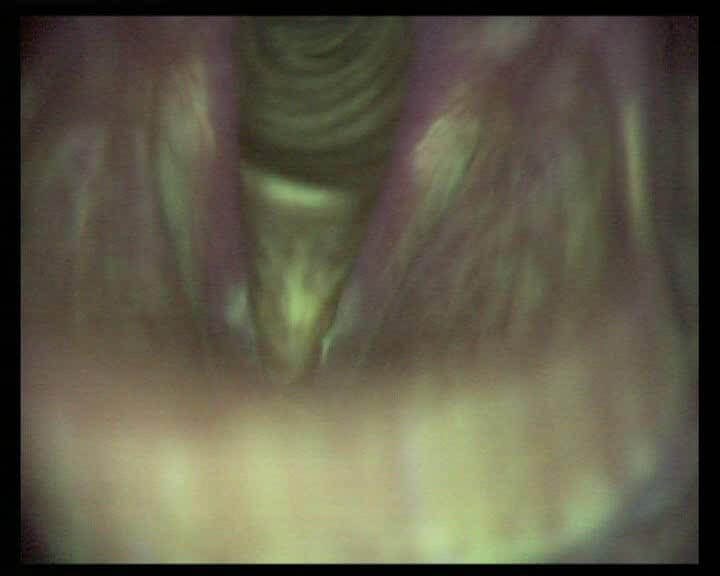 Рис.4 Видеоэндоскопия и аутофлюоресцентная эндоскопия гортани пациента с раком левой голосовой складки   T1N0Mx (рак in situ левой голосовой складки) (AF-) Рис.4 Видеоэндоскопия и аутофлюоресцентная эндоскопия гортани пациента с раком левой голосовой складки   T1N0Mx (рак in situ левой голосовой складки) (AF-)