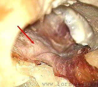 Рис. 6. Укладка височной аутофасции. Примечание: (красная стрелка) фрагмент аутофасции Рис. 6. Укладка височной аутофасции. Примечание: (красная стрелка) фрагмент аутофасции