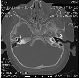 Рис. 1.  Данные КТ пациентки К. Примечание: Так, справа (1) улитка представлена небольшой полостью, максимальный размер которой составляет не более 5 мм, преддверие и полукружные каналы отсутствуют. Слева (2) улитка представлена единой полостью без внутре Рис. 1.  Данные КТ пациентки К. Примечание: Так, справа (1) улитка представлена небольшой полостью, максимальный размер которой составляет не более 5 мм, преддверие и полукружные каналы отсутствуют. Слева (2) улитка представлена единой полостью без внутре