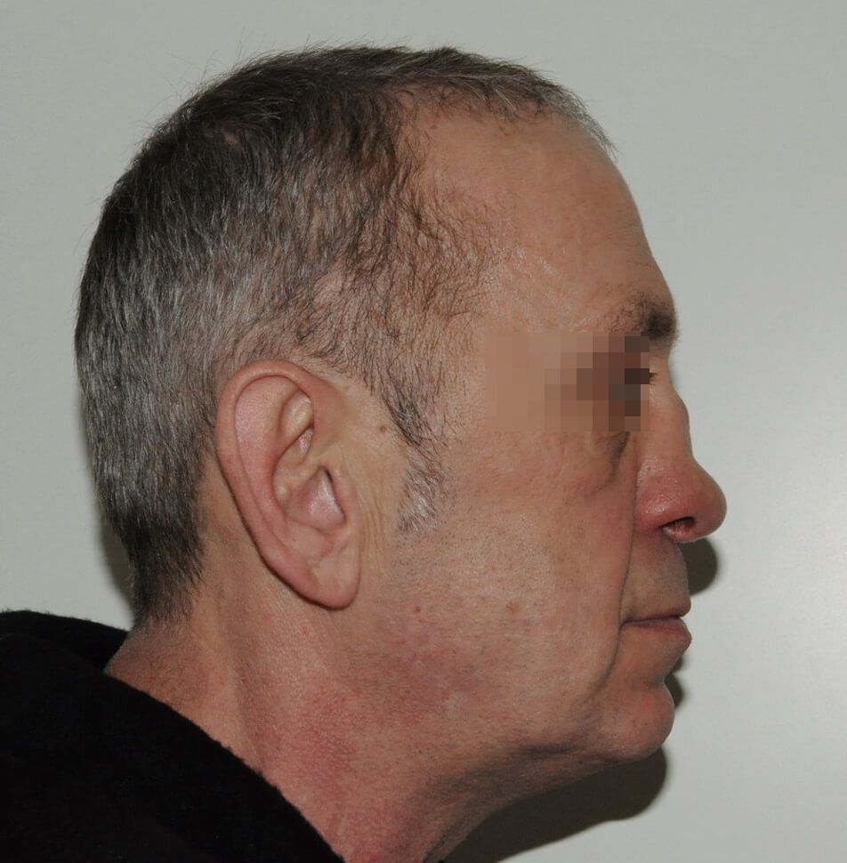 До операции До операции